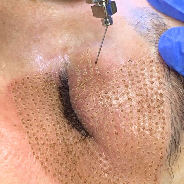 Plasma Pen Fibroblast eye treatment in Prahran Melbourne. Bodyvision Clinic.
