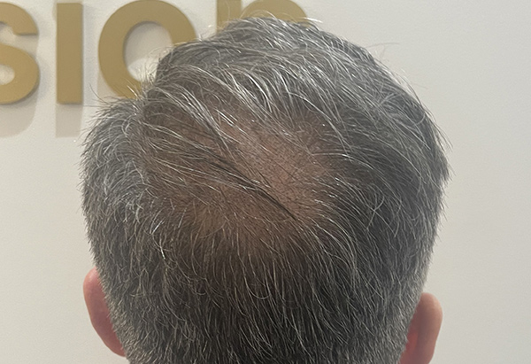 A man's head after he has had scalp micropigmentation treatment