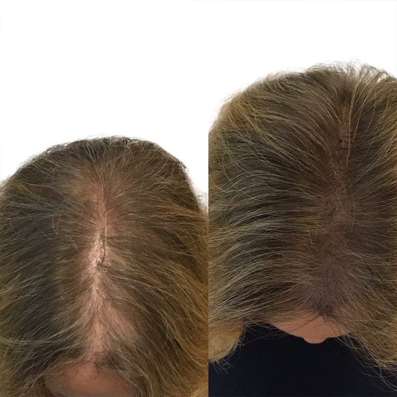 A woman's head before and after she has had scalp micropigmentation treatment